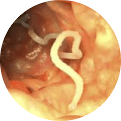 tapeworm symptoms