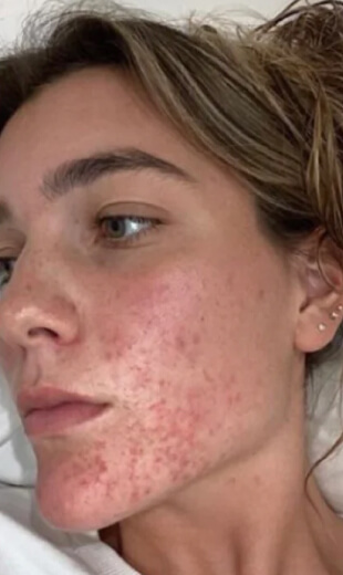 clear skin results
