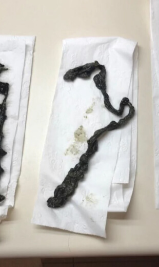parasite symptoms before