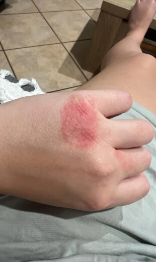 rash before cleanse