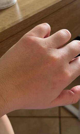 clear skin result
